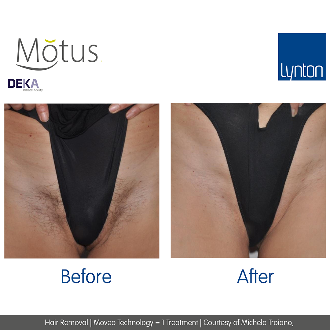 Laser Hair Removal