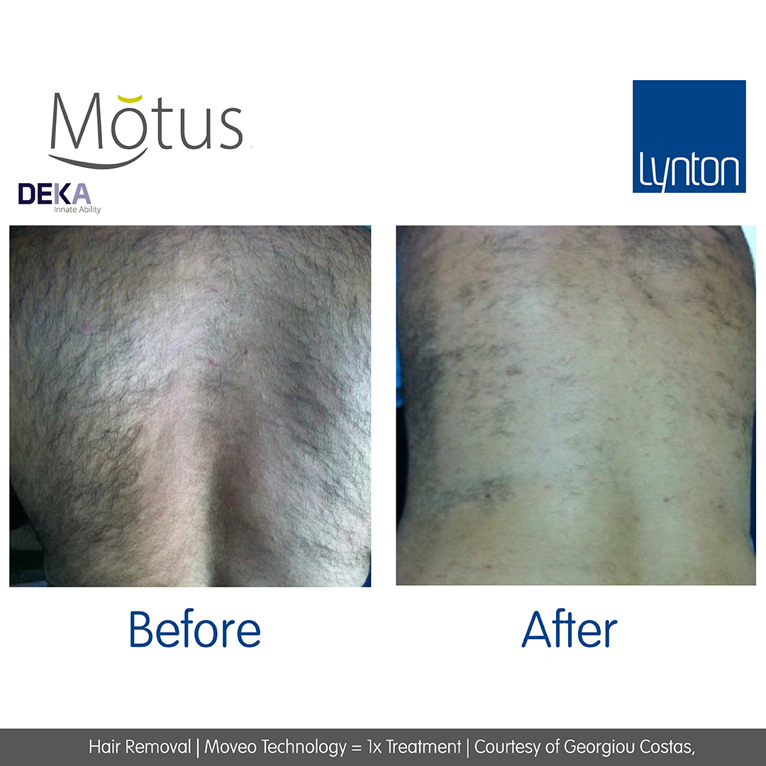 Laser Hair Removal