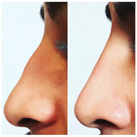 Non Surgical Rhinoplasty
